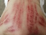 Gua sha jäljet